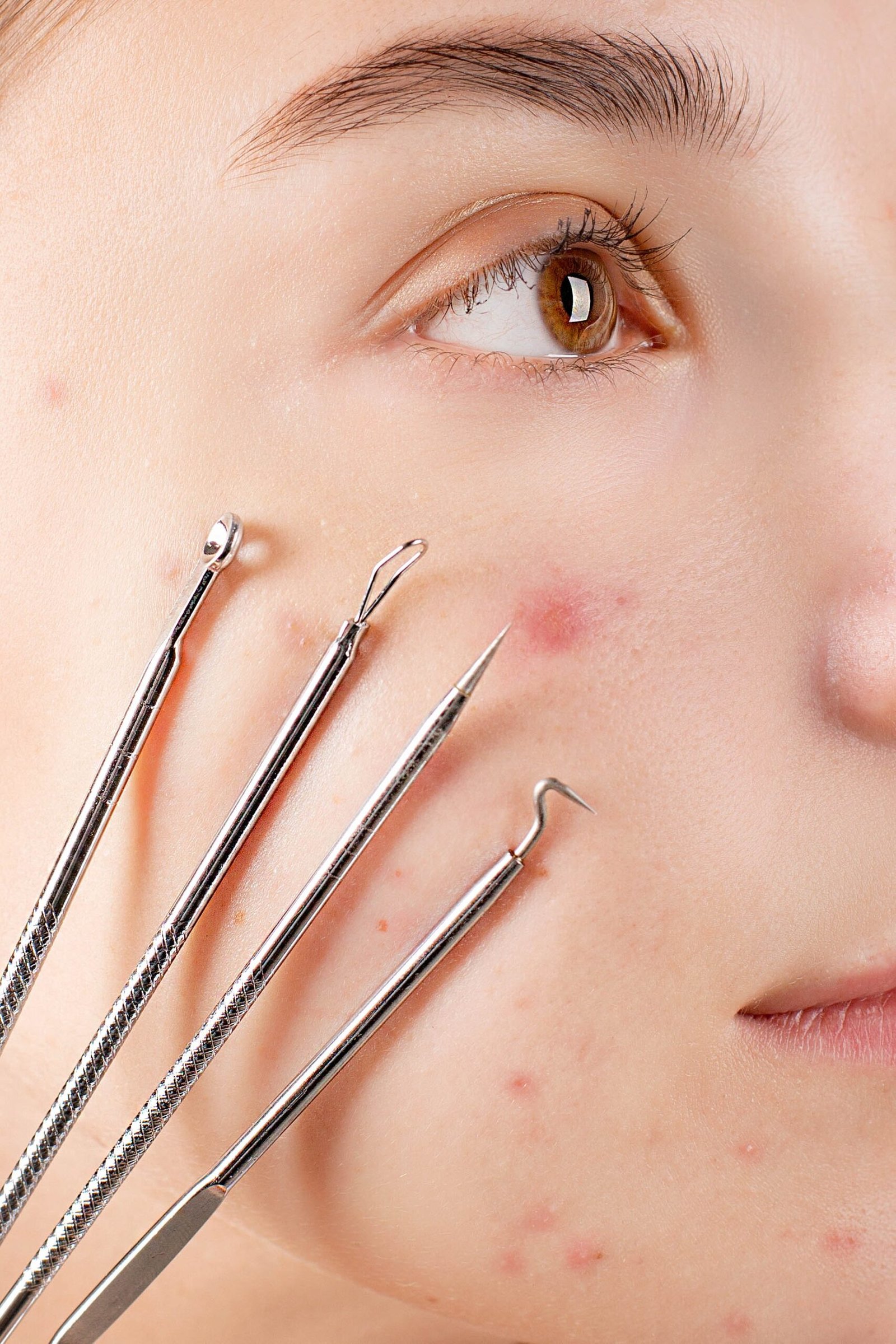 The Ultimate Guide to Acne Spot Treatments